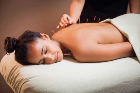 Acupuncture – 9 facts and why you need it